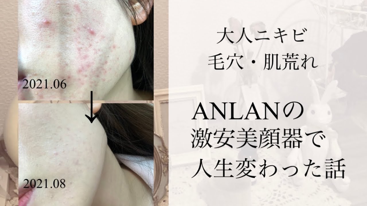 【毛穴・ニキビ】激安美顔器で人生変わった話