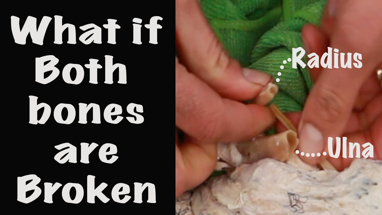 How to repair broken Wing? Ulna and Radius.