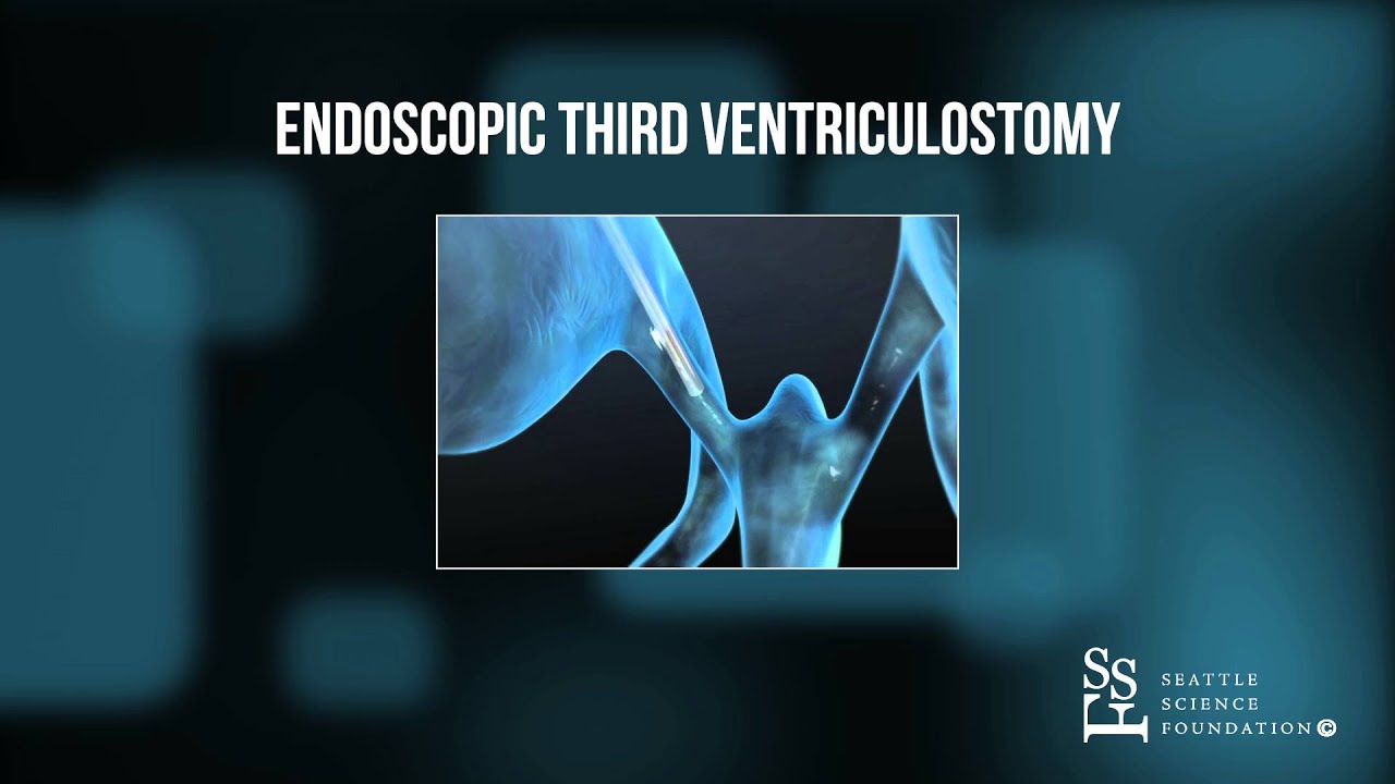 Endoscopic Third Ventriculostomy Animation
