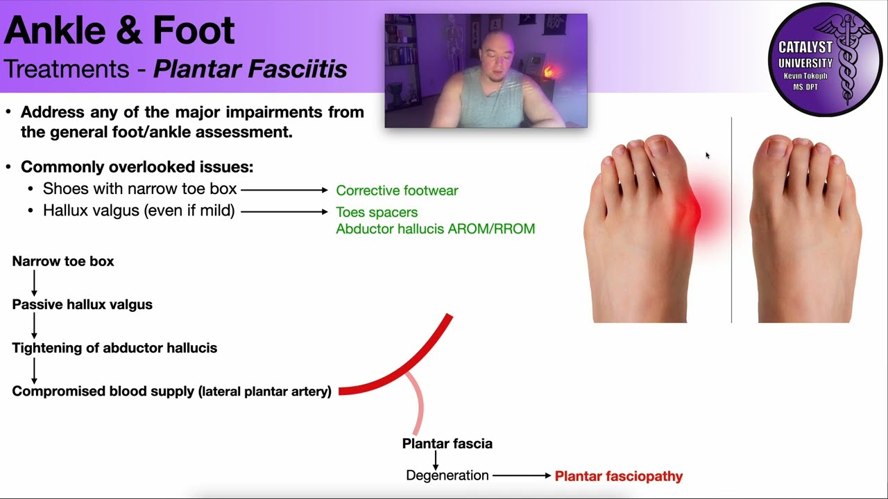 Treating Plantar Fasciitis 🦶 More Than Just Stretches & Strengthening