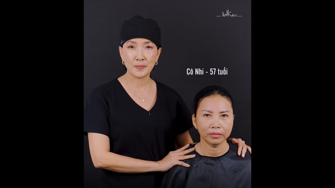 [Bác sĩ Thảo] “GIẢI CỨU” GƯƠNG MẶT C.HẢY XỆ Ở TUỔI 57 VỚI 14CC FILLER MD CODES!