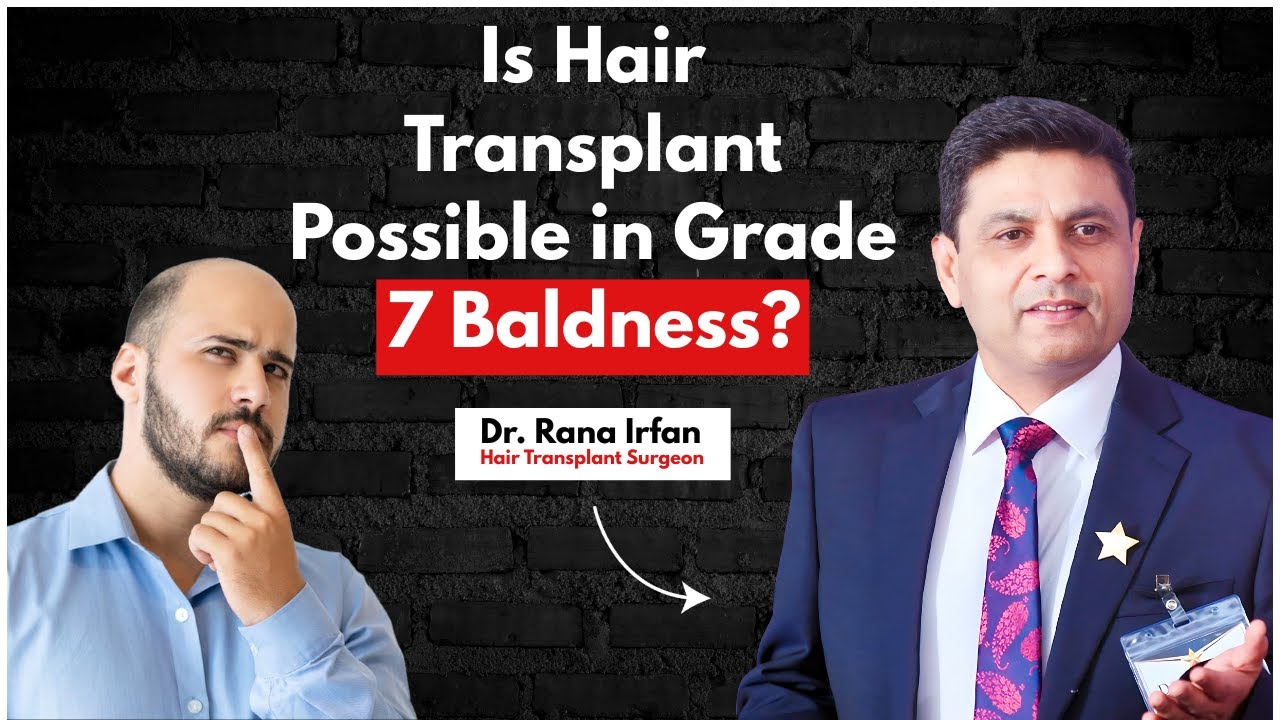 Is Hair Transplant Possible in Grade 7 Baldness? |Myths About Grade 7 Baldness Hair Transplants