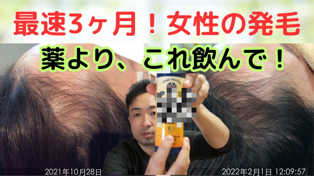 【女性の薄毛】M字ハゲ、薄毛の改善法を実際の発毛症例で解説。女性の髪を3ヶ月で生やす方法をお伝えします。