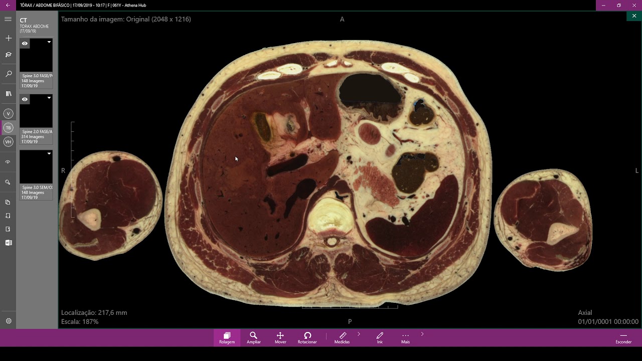 Anatomia da Vesícula biliar