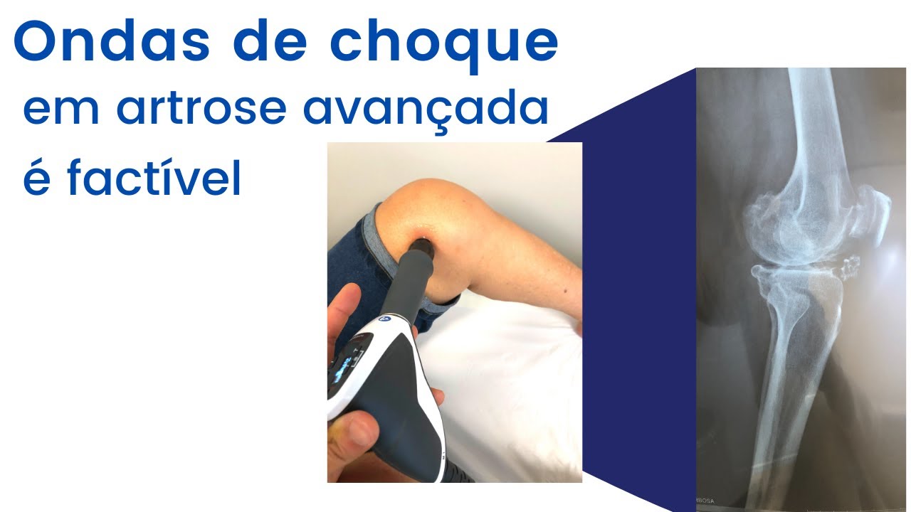 É válido fazer ondas de choque para artrose avançada de joelho?