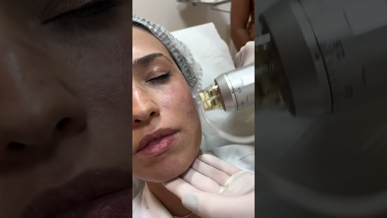 A Radiofrequência Microagulhada trata cicatrizes, flacidez, estrias o rejuvenescimento face e corpo