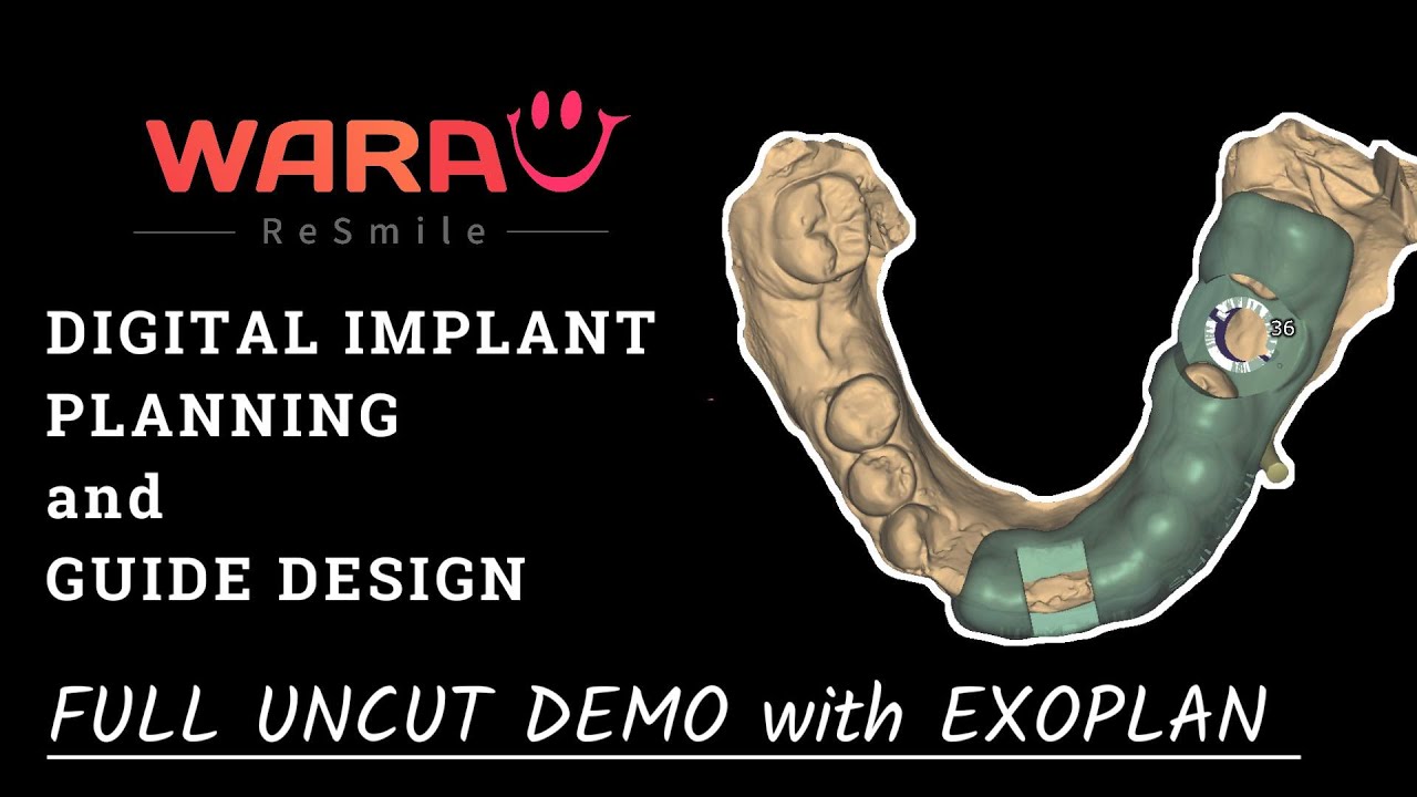 Full Case Demo: Digital Implant Planning & Surgical Guide Design in Exoplan