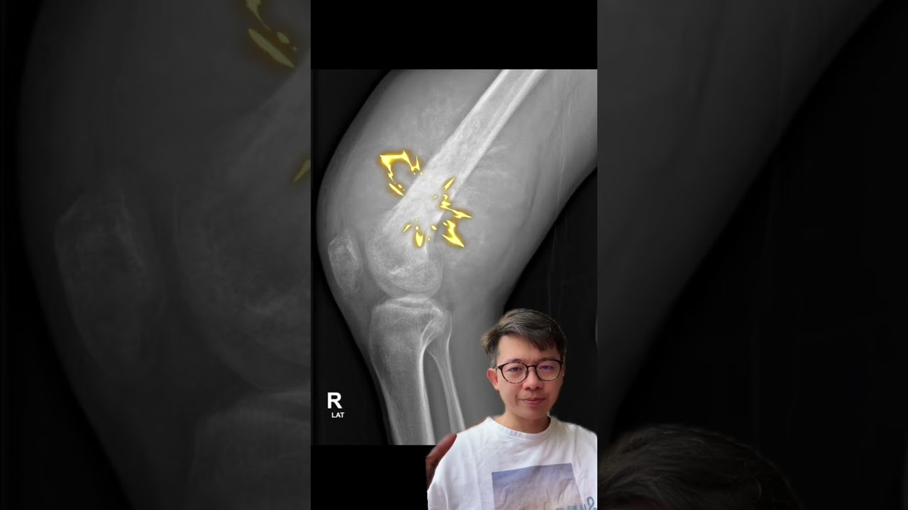 ⛔️ SARCOMA ⛔️  BENJOLAN YANG TERNYATA KANKER TULANG!