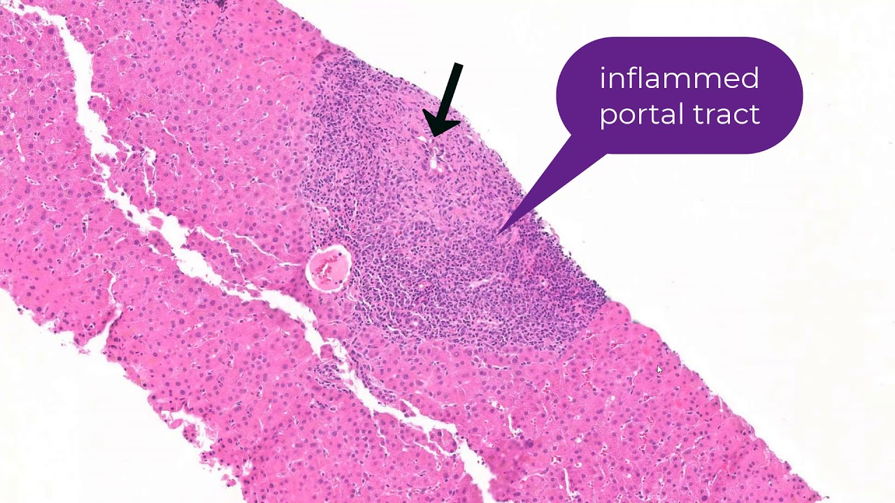 Histology of Primary Biliary Cholangitis