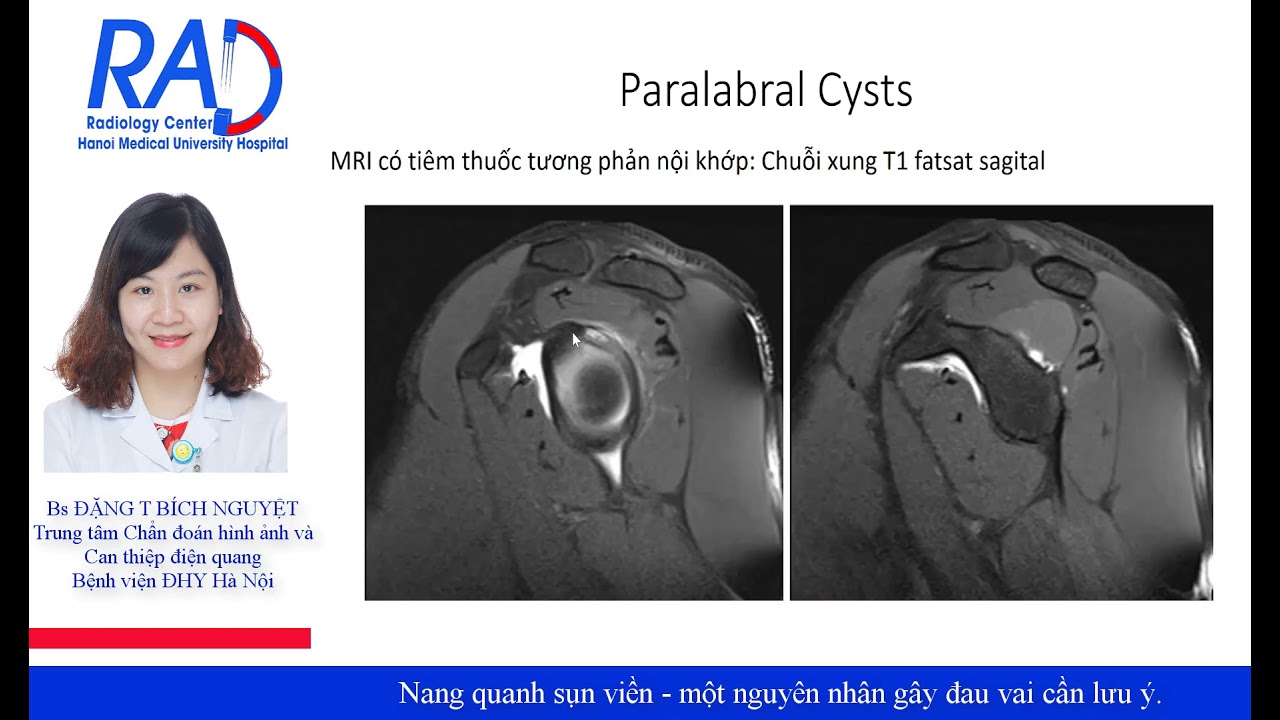 Nang quanh sụn viền, một nguyên nhân gây đau vai cần chú ý