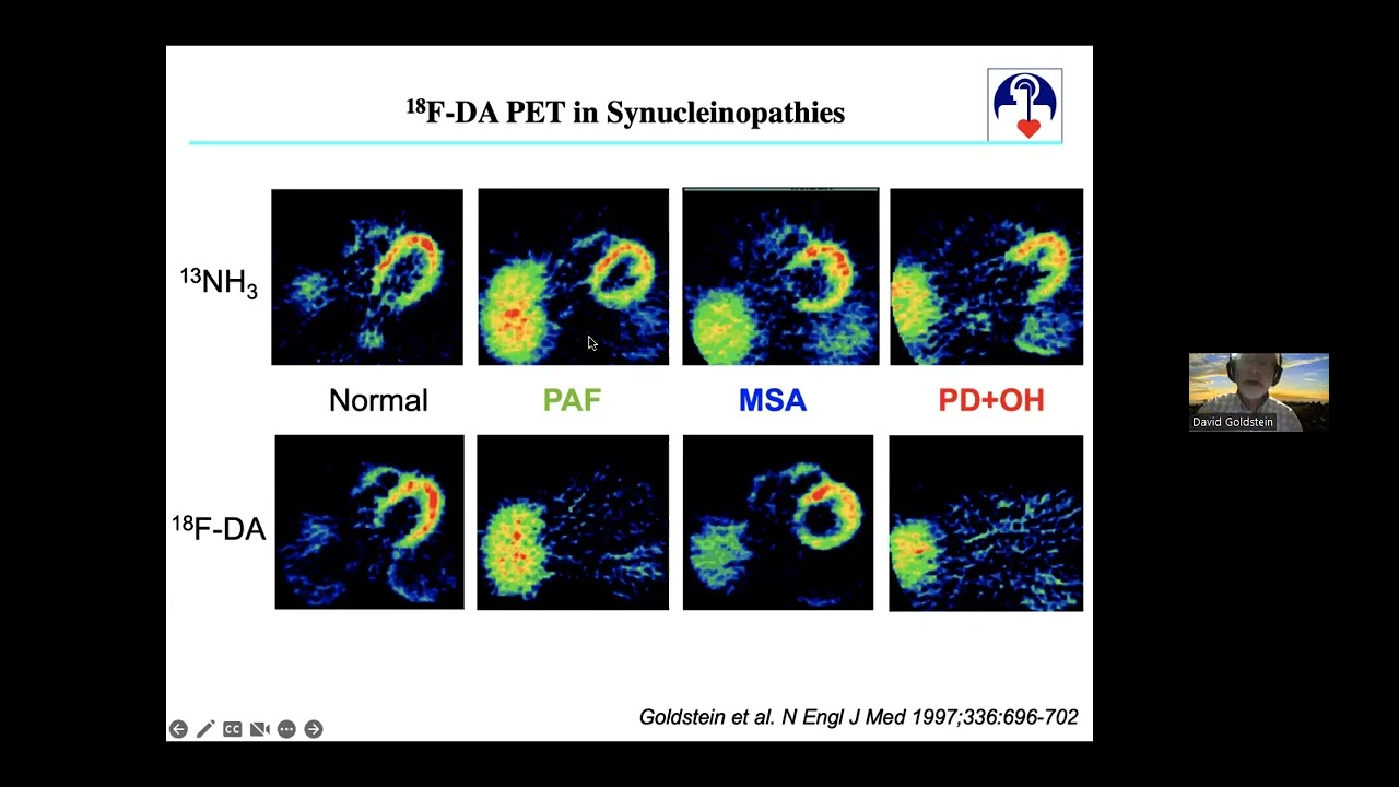 How to Manage Dysautonomia in Parkinson's