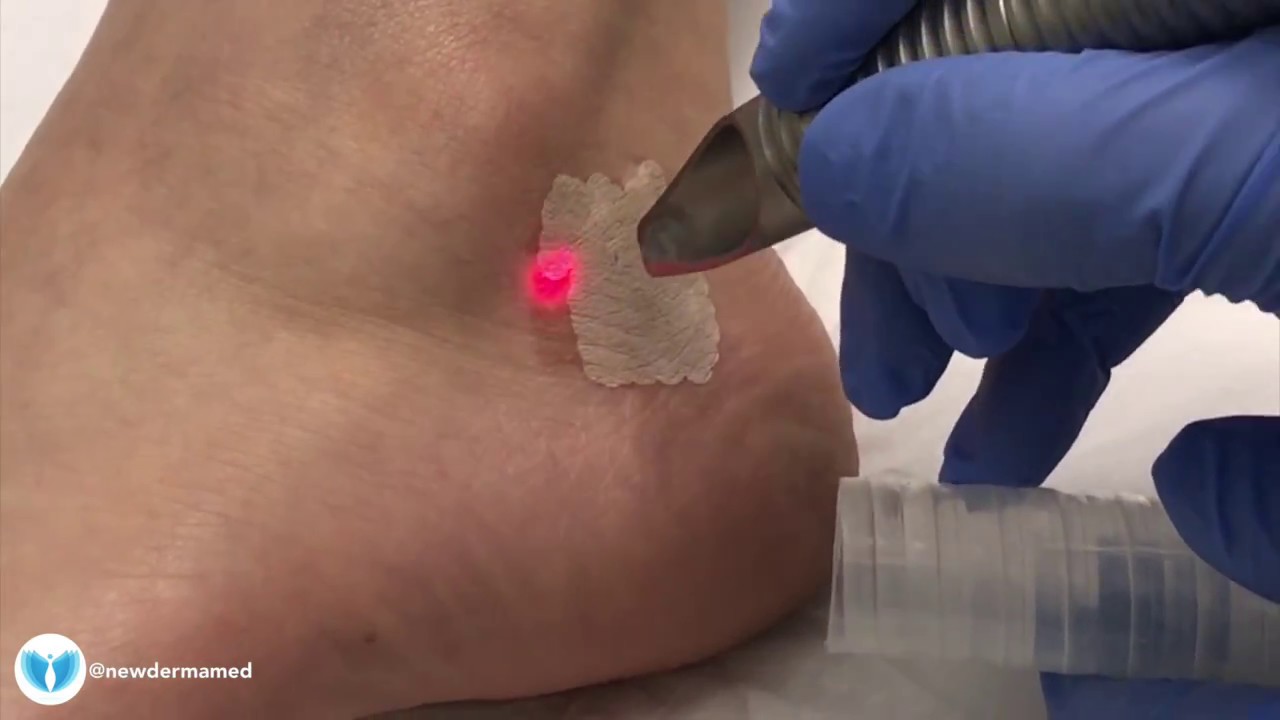 Laser Birthmark Removal