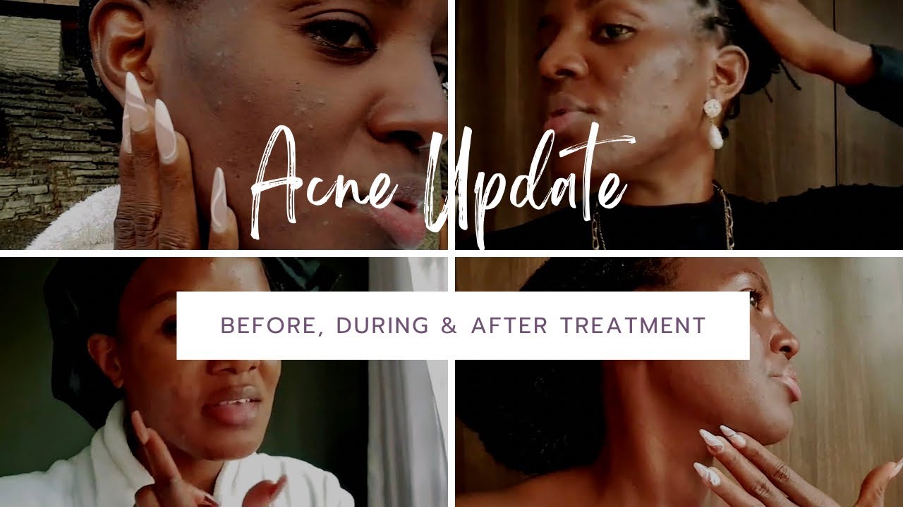 VLOG// MY FULL ACNE JOURNEY | Recovery With Clabane Skin Care