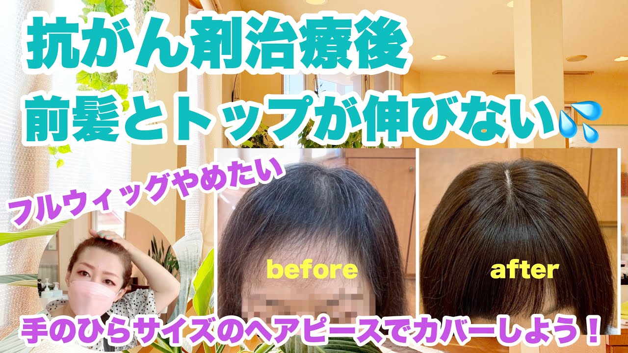 【抗がん剤治療の脱毛】なかなか伸びない前髪やトップはヘアピースでカバー！ #抗がん剤 #ウィッグ #脱毛症