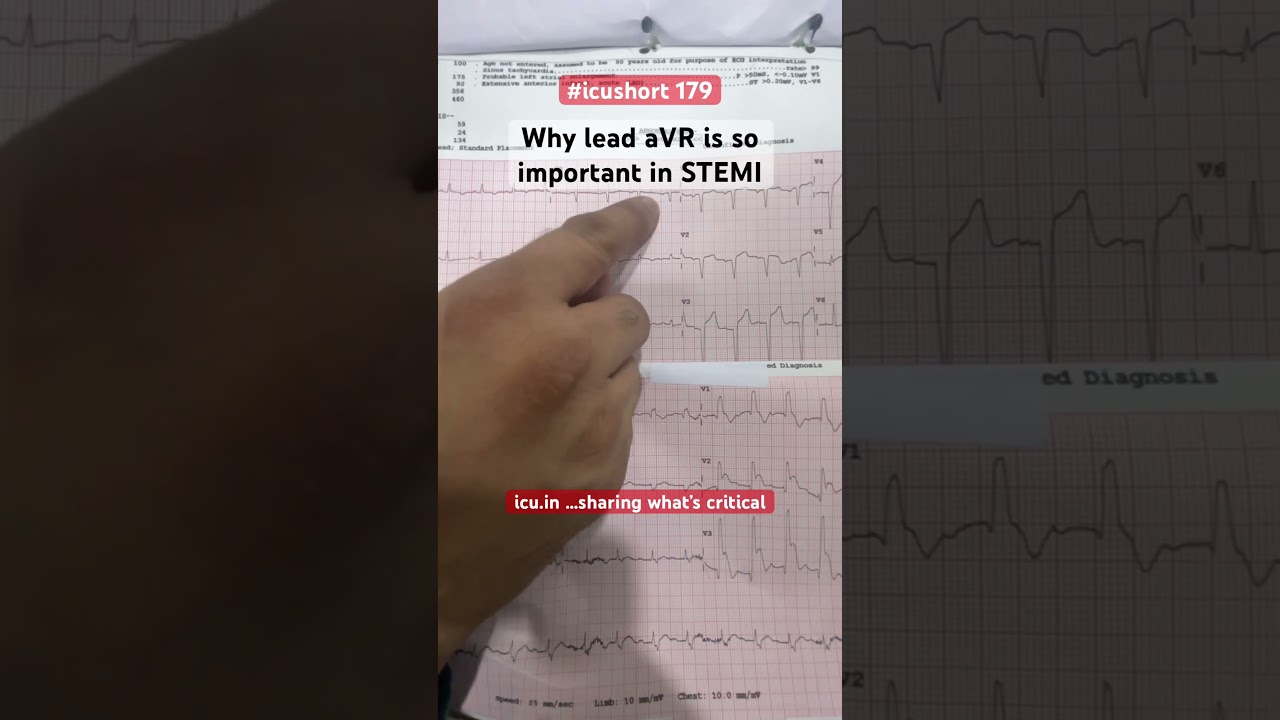 #icushort 179: Why lead aVR is so important in STEMI #esbicm #shorts