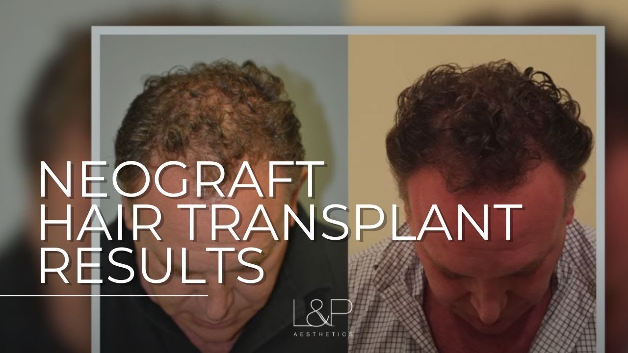 For The Face - Results of a NeoGraft Hair Transplant | Bay Area Hair Restoration