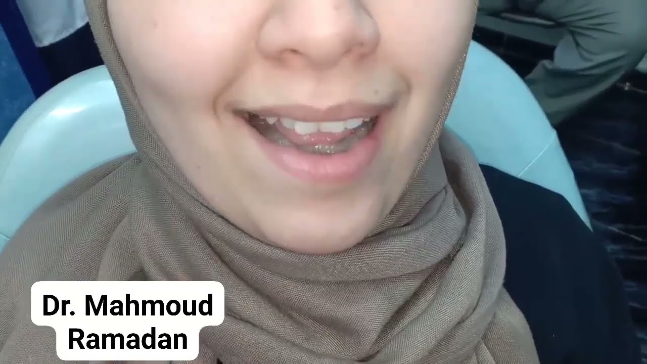 سما وحالة شفاء جديدة من الإنزلاق الغضروفى المؤقت لمفصل الفكين
