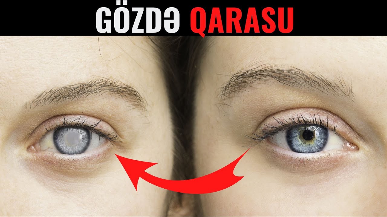 Gözə QARASU Gəlməsi - Sizdə Bu Əlamətlər Varsa...