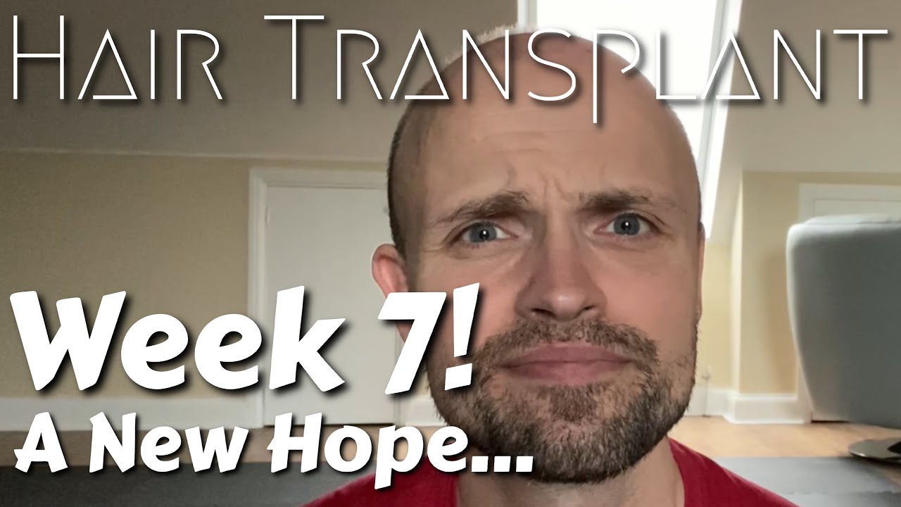 Week 7, Hair Transplant Update