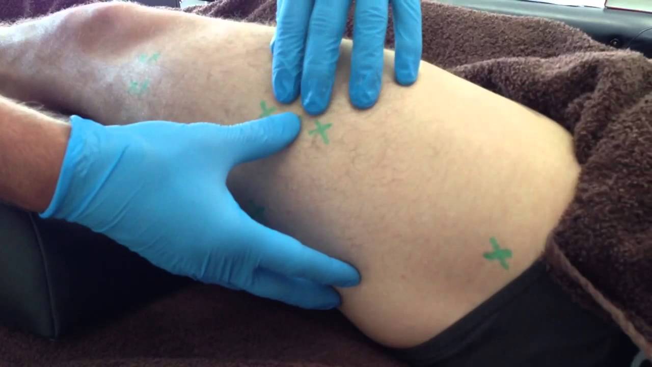 Сухое иглоукалывание: латеральная широкая мышца бедра