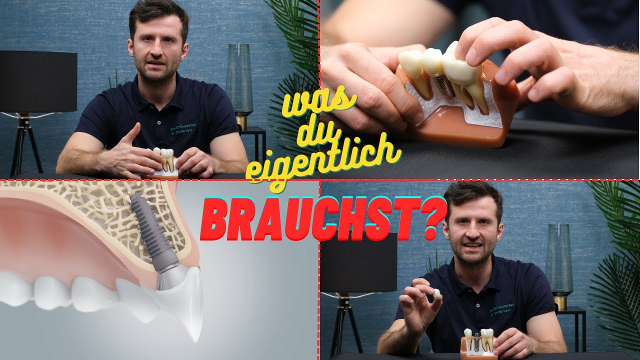 Zahnkrone und Zahnimplantat | Funktionsweise und Unterschied