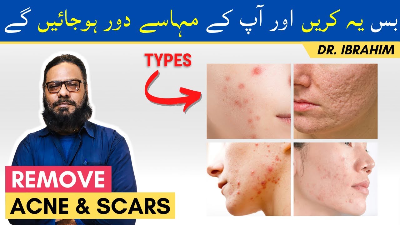 Muhase/Acne Chehre Se Khatam Karne Ka Tarika | How To Get Rid Of Acne/Zits/Pimples (Step-by-Step)