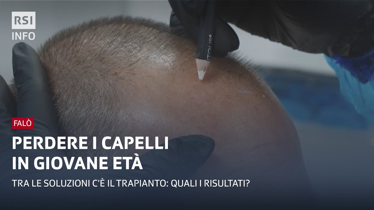 Perdere i capelli in giovane età | Falò | RSI Info