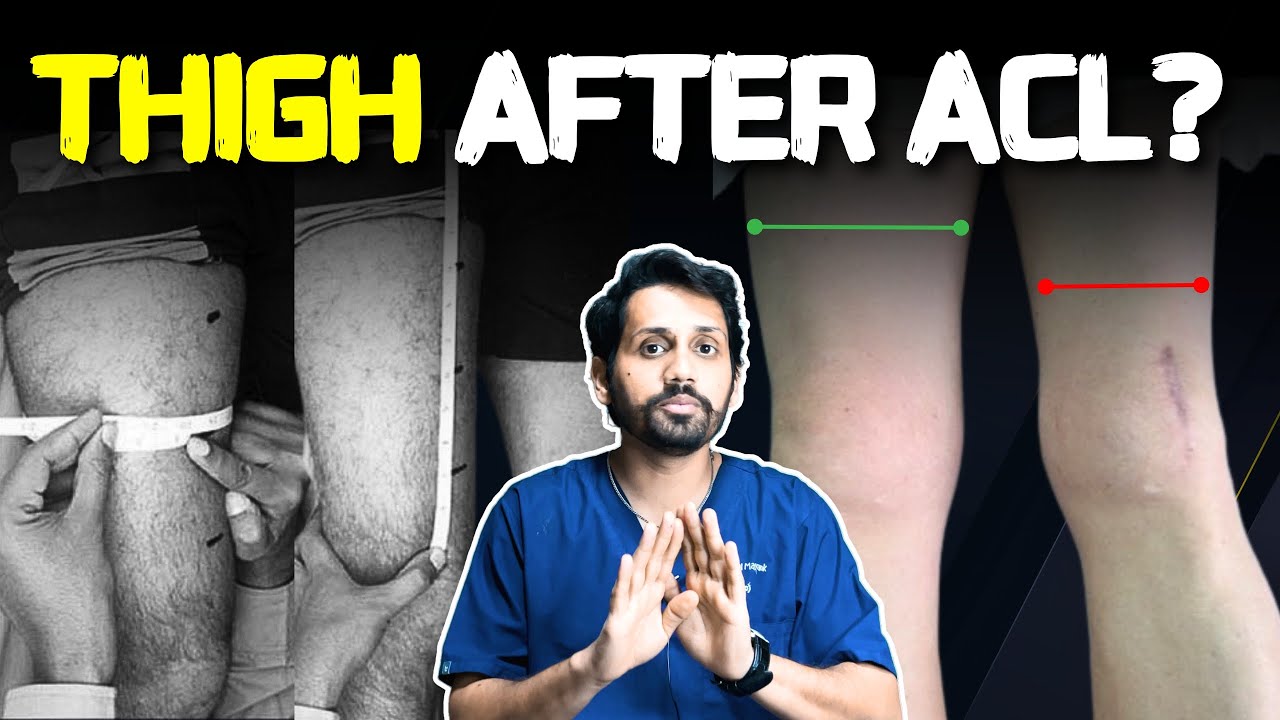 Why Your Quads Are Still Weak After ACL Surgery