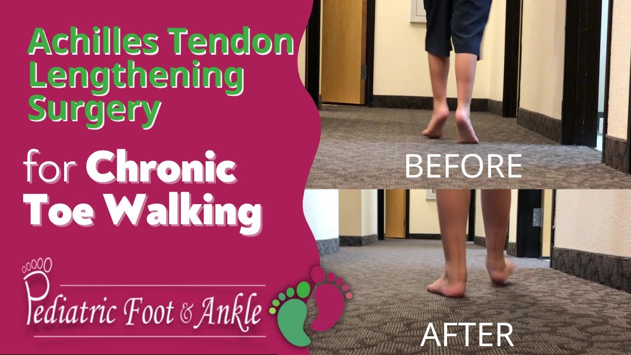 Achilles Tendon Lengthening Surgery for Toe Walking Male 7 Years Old