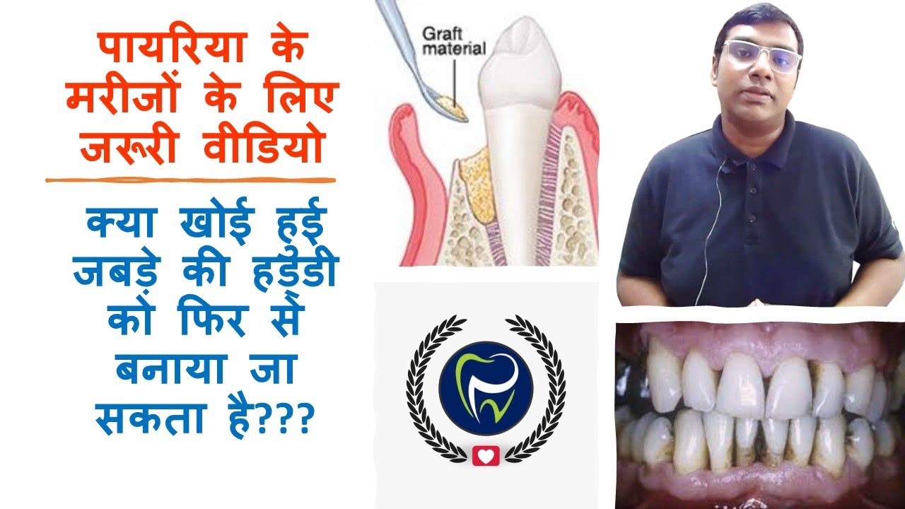 Dr Rudra Mohan पायरिया के मरीजों के लिए जरूरी वीडियो |क्या खोई हुई हड्डी को फिर से बनाया जा सकता है?