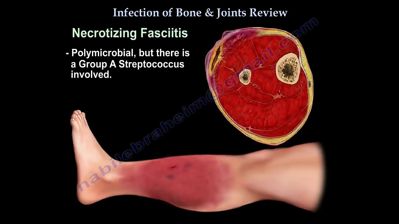 Bone and Joint Infections: Causes, Symptoms, and Treatment Options