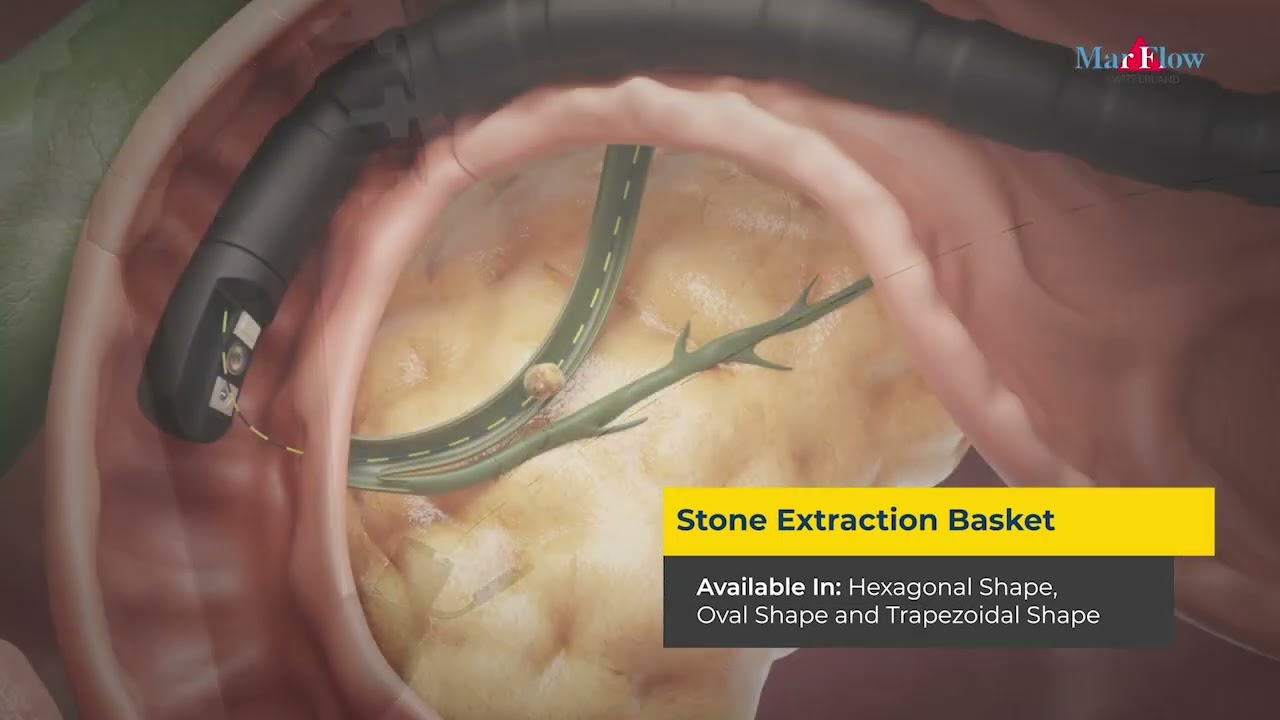 Endoscopic Retrograde Cholangiopancreatography (ERCP) | Procedure and Product Overview