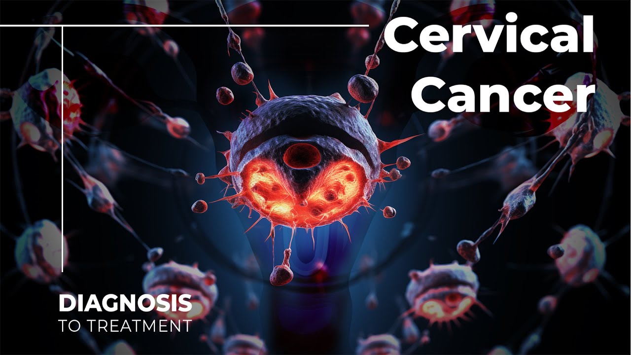 Cervical Cancer: What Are The Options?