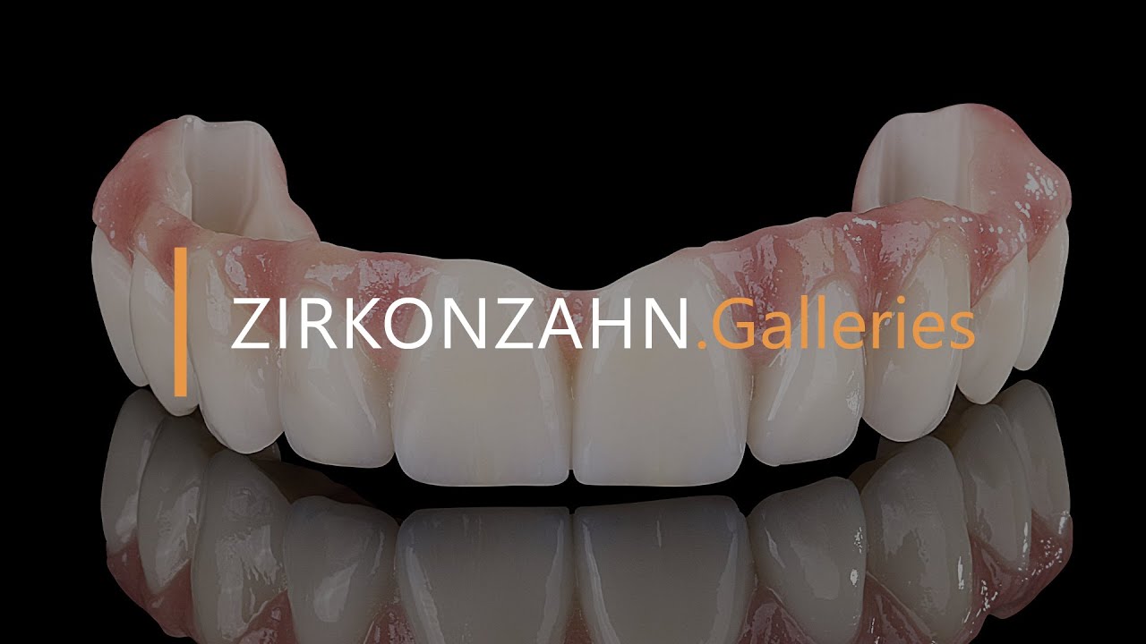Double Screw Metal technique on a maxillary Prettau® Bridge | Zirkonzahn.Galleries