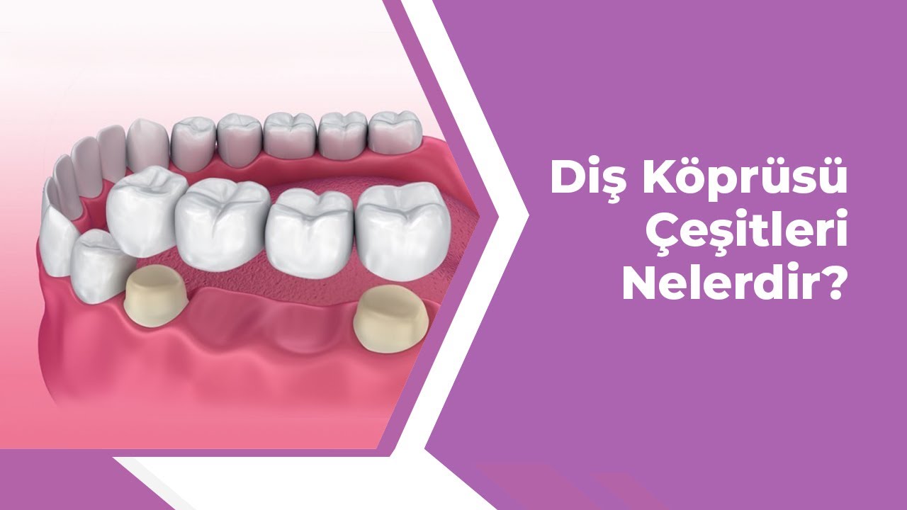 Diş Köprüsü Çeşitleri Nelerdir?