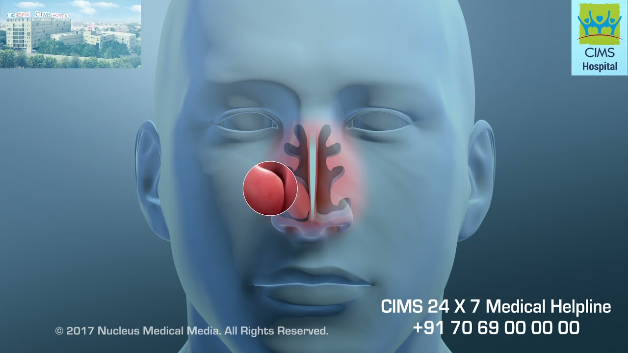 Nasal Turbinate Reduction (Hindi) – CIMS Hospital