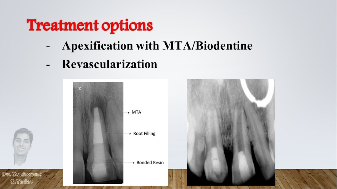Open apex - Diagnosis and treatment options