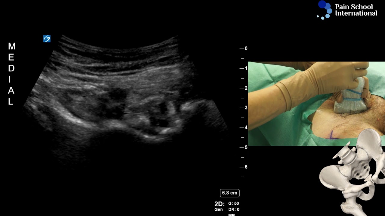 Dr Agnes Stogicza - Cryoablation E-Learning Seminar 1 Session 1: Hip denervation