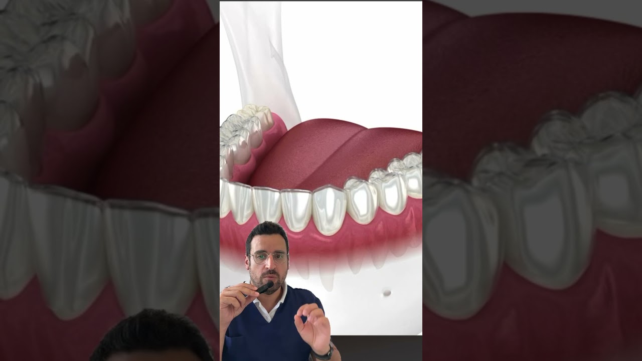 LES GOUTTI&Egrave;RES orthodontiques : orthodontie d&rsquo;alignement des dents