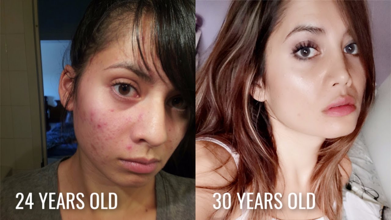 RETIN A BEFORE AND AFTER 😱  *2 YEAR RESULTS!*