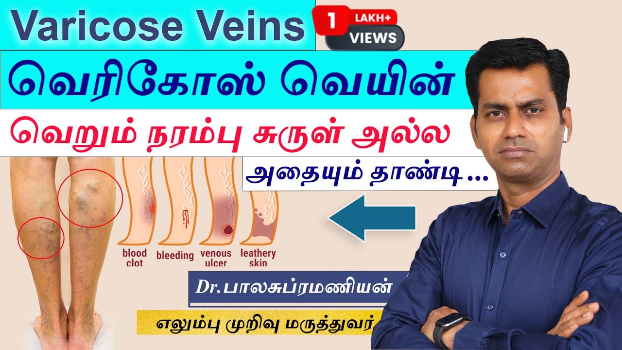 Stages of Varicose Vein-Cause | Symptoms | Treatment |வெரிகோஸ் வெயின் வெறும் ஒரு நரம்பு சுருள் அல்ல