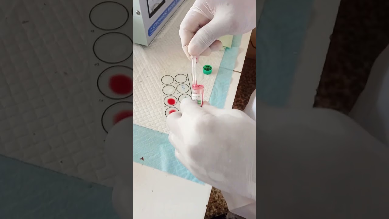 Haemoglobin genotype using electrophoresis 