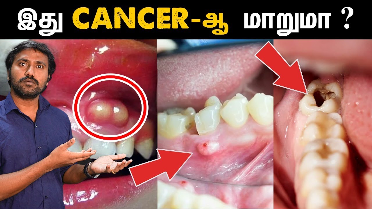 பற்களை பாதுக்காப்பாக வைத்திருப்பது எப்படி? | Root canal treatment explained in Tamil