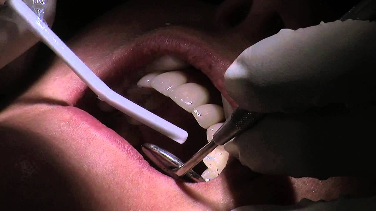 Smile make over with Dr. Parmar. Episode 17: porcelain occlusal adjustment