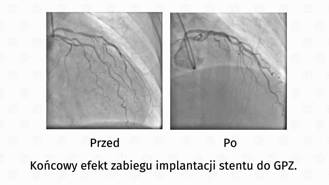Angioplastyka: por&oacute;wnanie - przed i po zabiegu