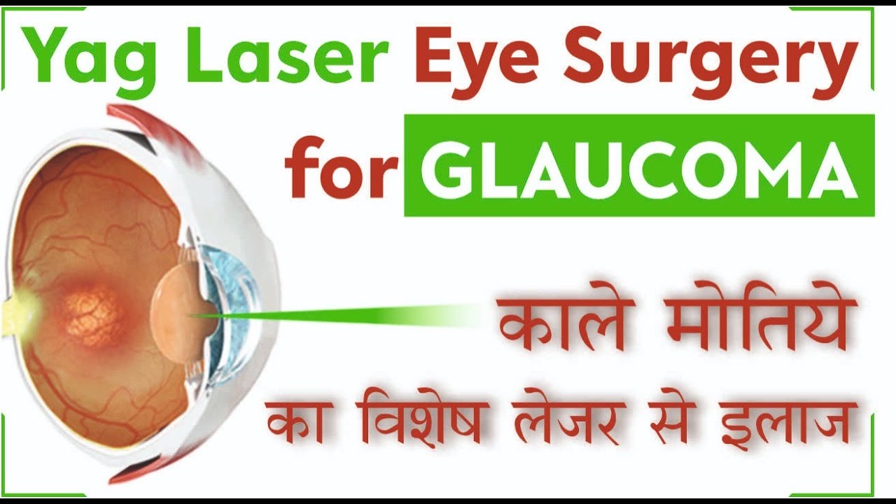 Yag Laser treatment - Laser Iridotomy for Glaucoma - काले मोतिये का लेजर से इलाज
