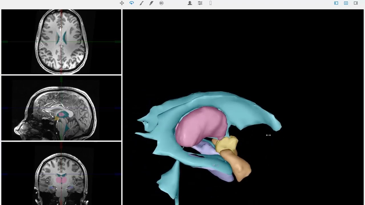 How to read an MRI of the brain