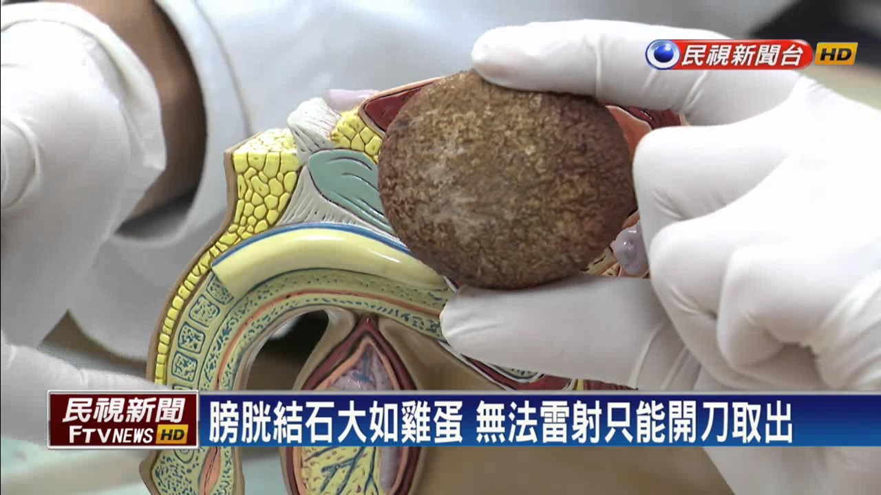 痛死人! 老翁膀胱塞滿結石 最大如