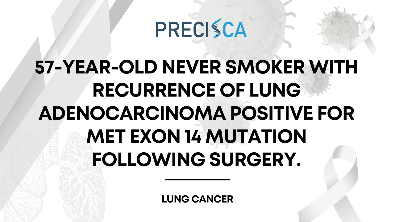 Expert Cancer Panel: Recurrent lung adenocarcinoma positive for MET exon 14 mutation s/p surgery