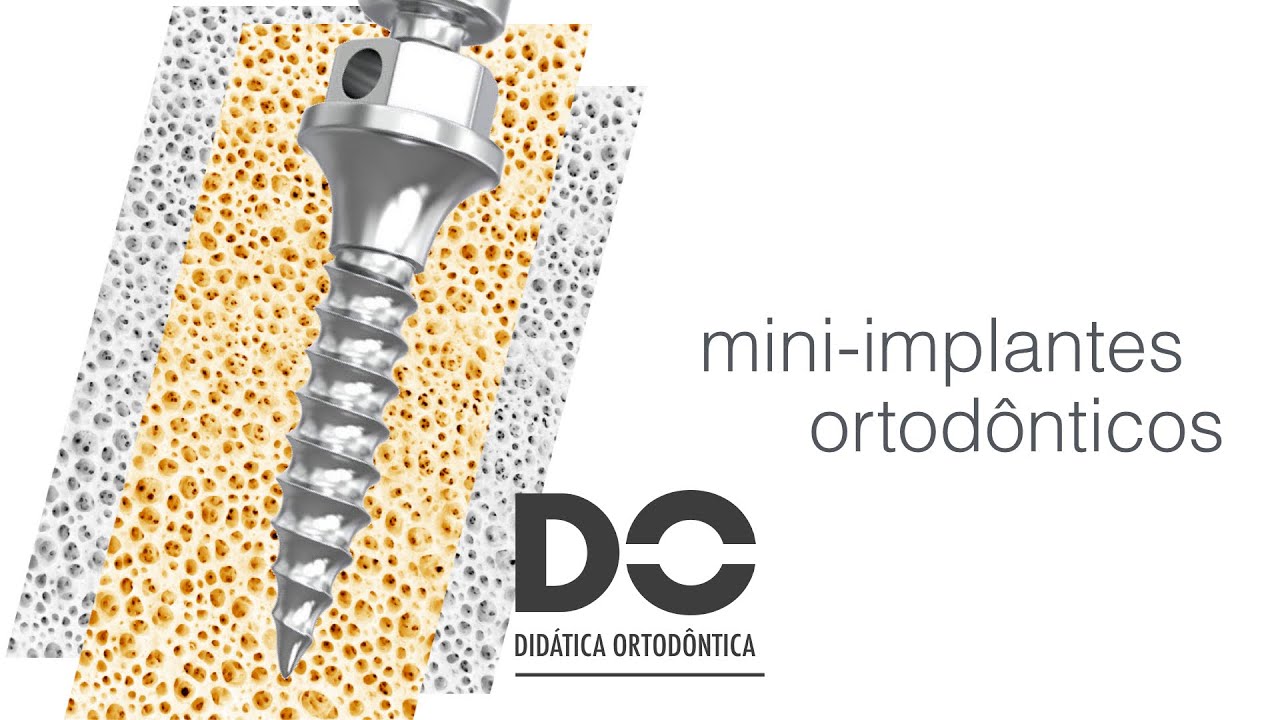 Mini-implantes ortodônticos. Parte 1